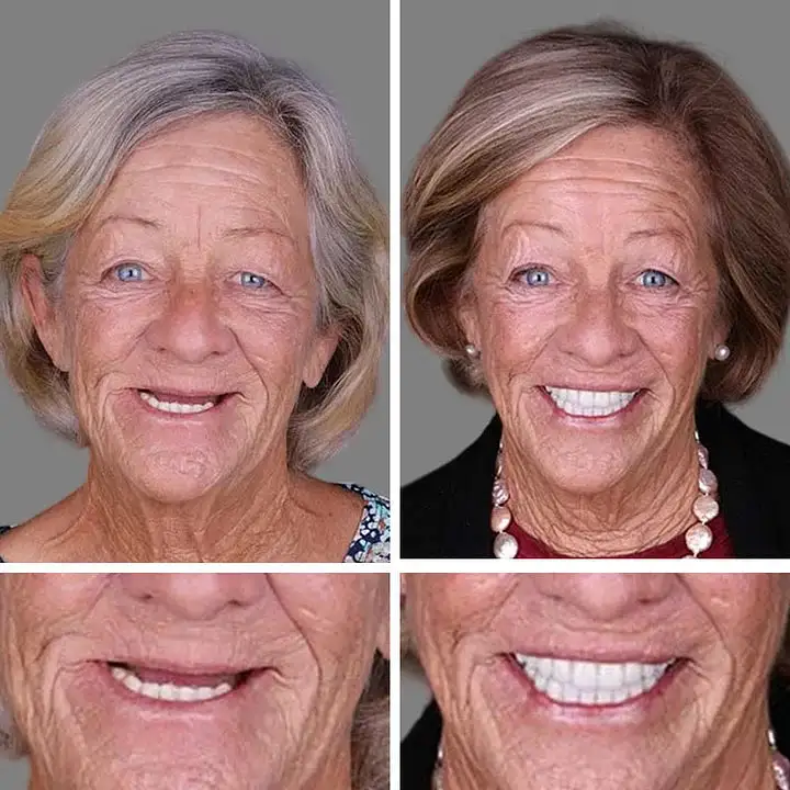 Yagoo™ Medical Full Denture with Strong Suctiond