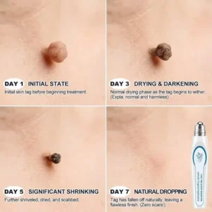 YAGOO® 7-Day Skin Tag & Spot Eraser Painless & Scar-Free Advanced Imperfection Removal Rollerball Pen