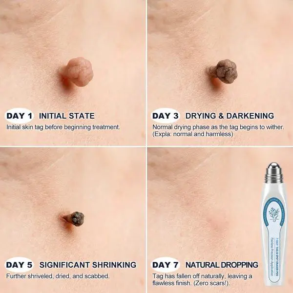 Official Store🎉YAGOO™ 7-Day Skin Renewal Roller | Formulated with Australian Tea Tree Oil & Salicylic Acid for precise spot application to eliminate skin tags at the source.
